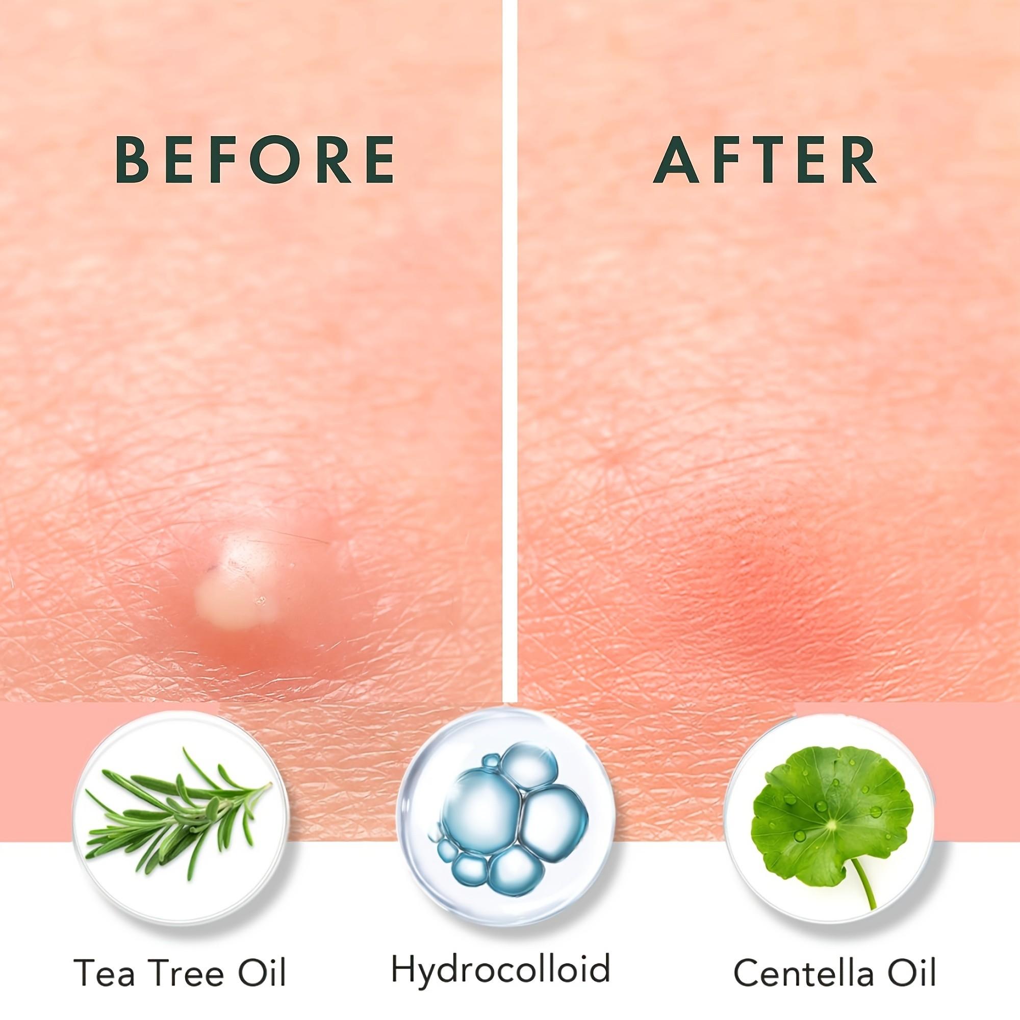 180/360/720 Stück Akne-Pflaste – Skincare Oil Control Bewertung und Preis
